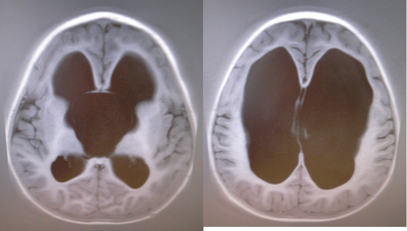 kaiden-hinshelwood-arachnoid-cyst-hydrocephalus